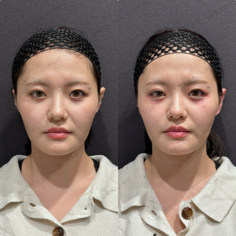 涙袋ヒアルロン酸ボルベラ症例写真