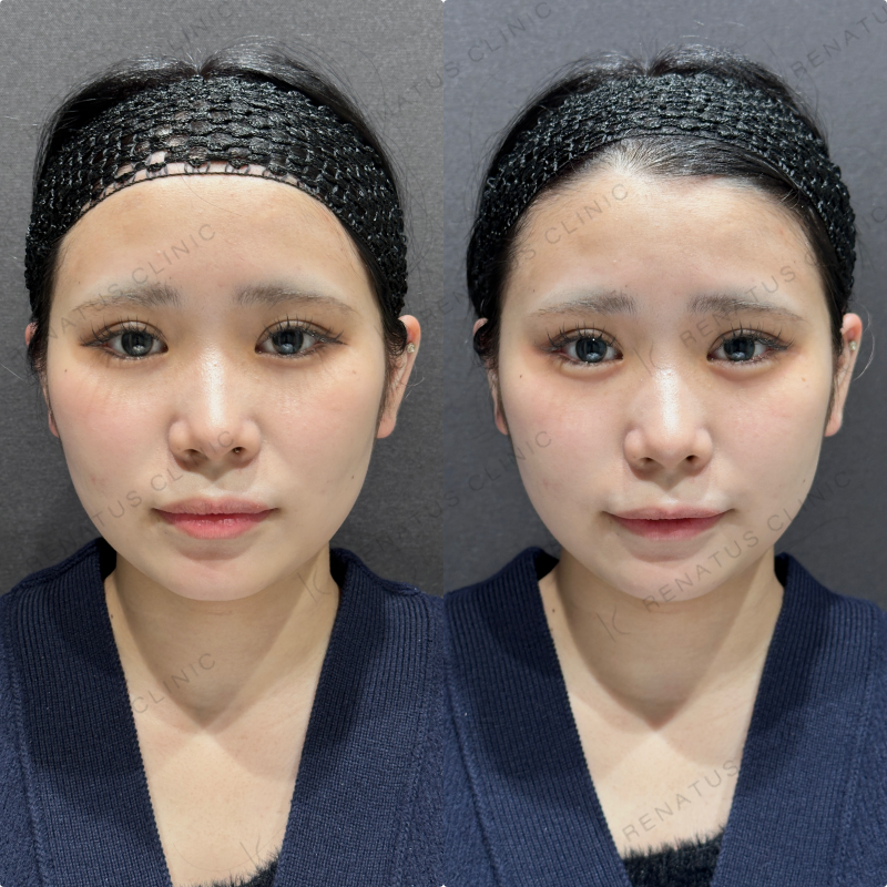 涙袋ヒアルロン酸ボルベラ症例写真