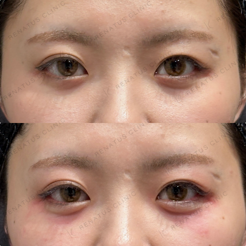 涙袋ヒアルロン酸ボルベラ症例写真