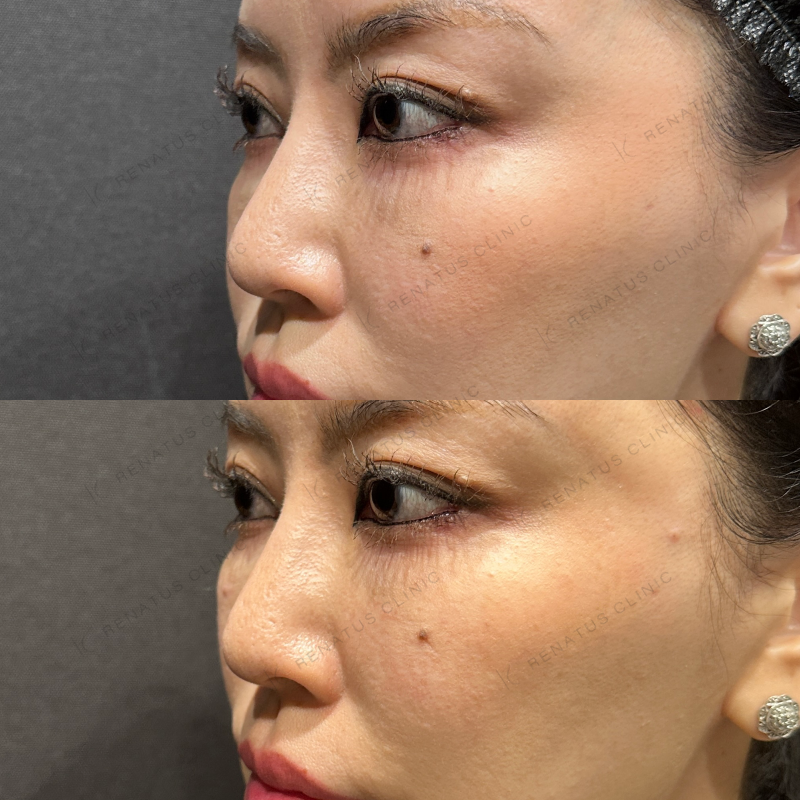 頬ヒアルロン酸ボリューマ症例写真