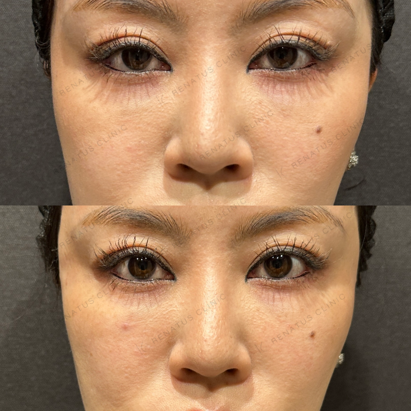 頬ヒアルロン酸ボリューマ症例写真