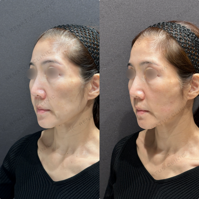 頬コケヒアルロン酸ボリューマ症例写真