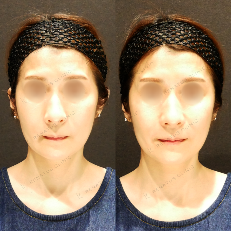 こめかみヒアルロン酸ボリューマ症例写真