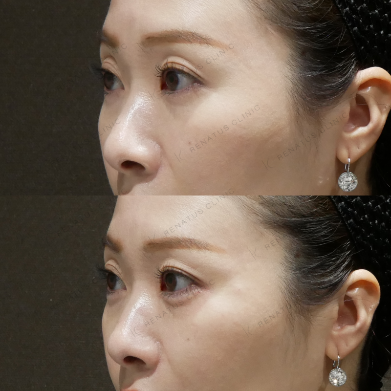 涙袋ヒアルロン酸ボルベラ症例写真