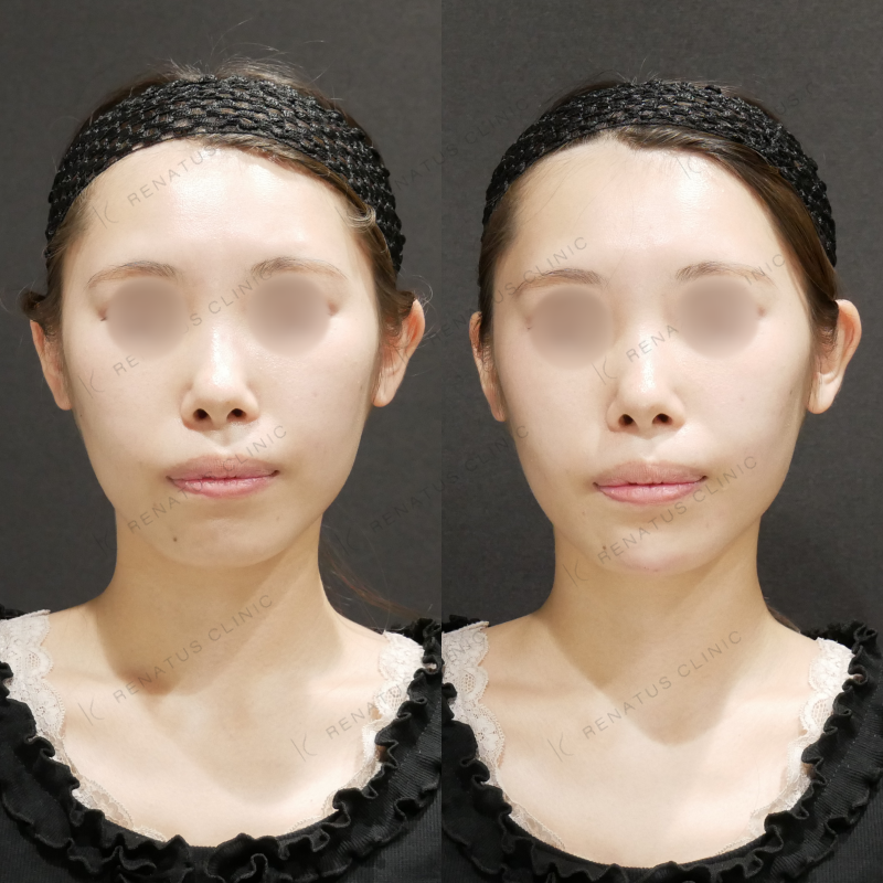 顎ヒアルロン酸ボラックス症例写真