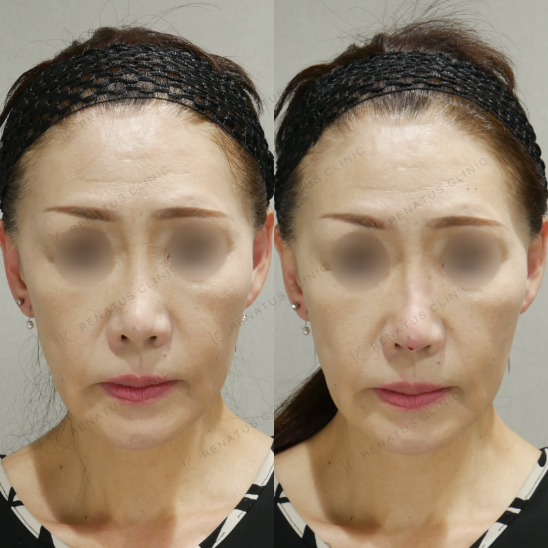 鼻ヒアルロン酸ボラックス症例写真