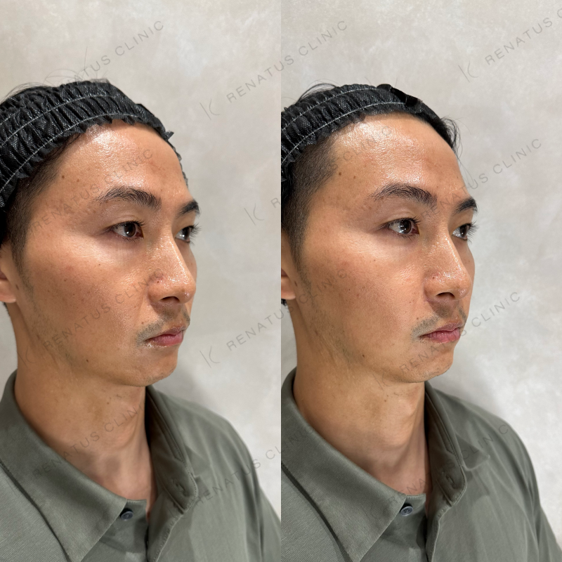 NLFヒアルロン酸ボリフト症例写真