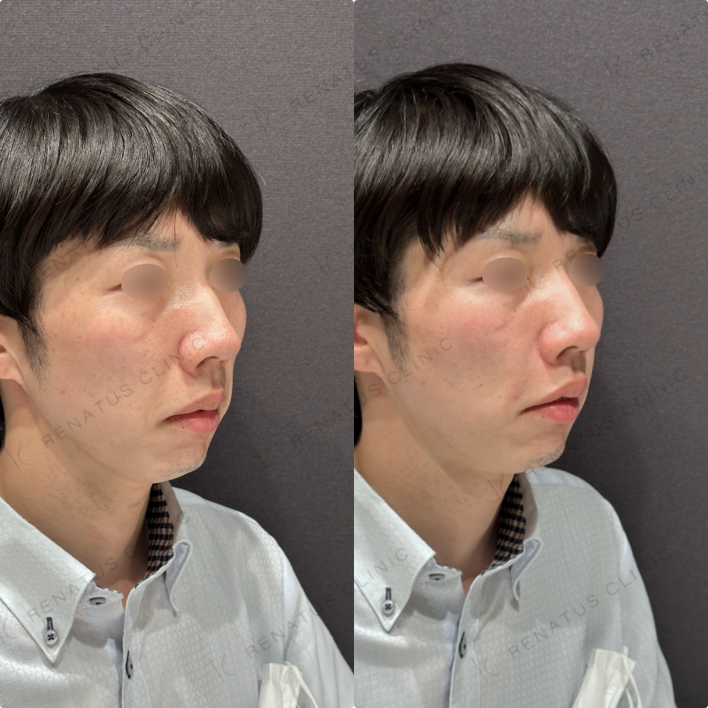 ほうれい線ヒアルロン酸ボリフト症例写真