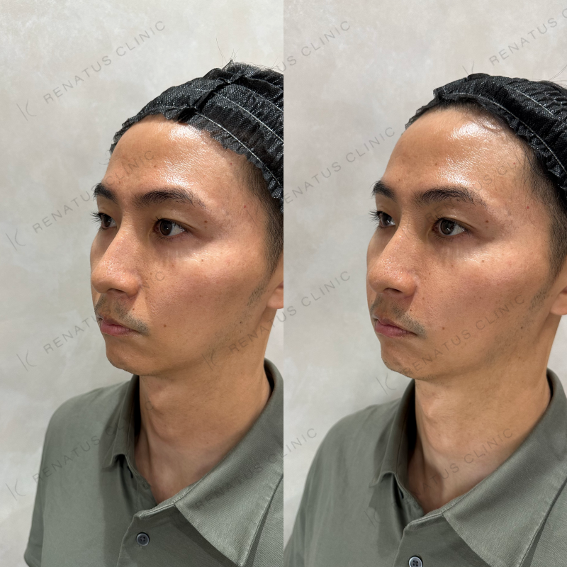 NLFヒアルロン酸ボリフト症例写真