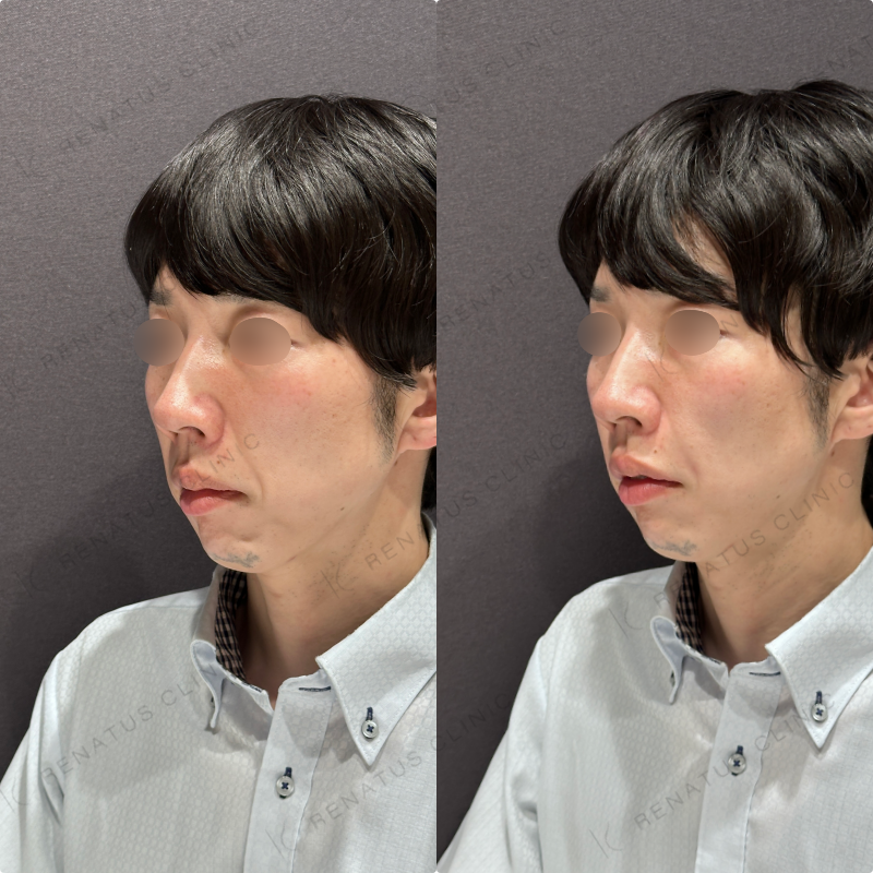 ほうれい線ヒアルロン酸ボリフト症例写真