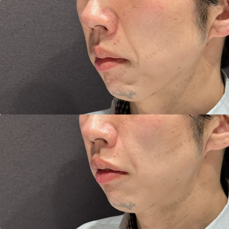 ほうれい線ヒアルロン酸ボリフト症例写真