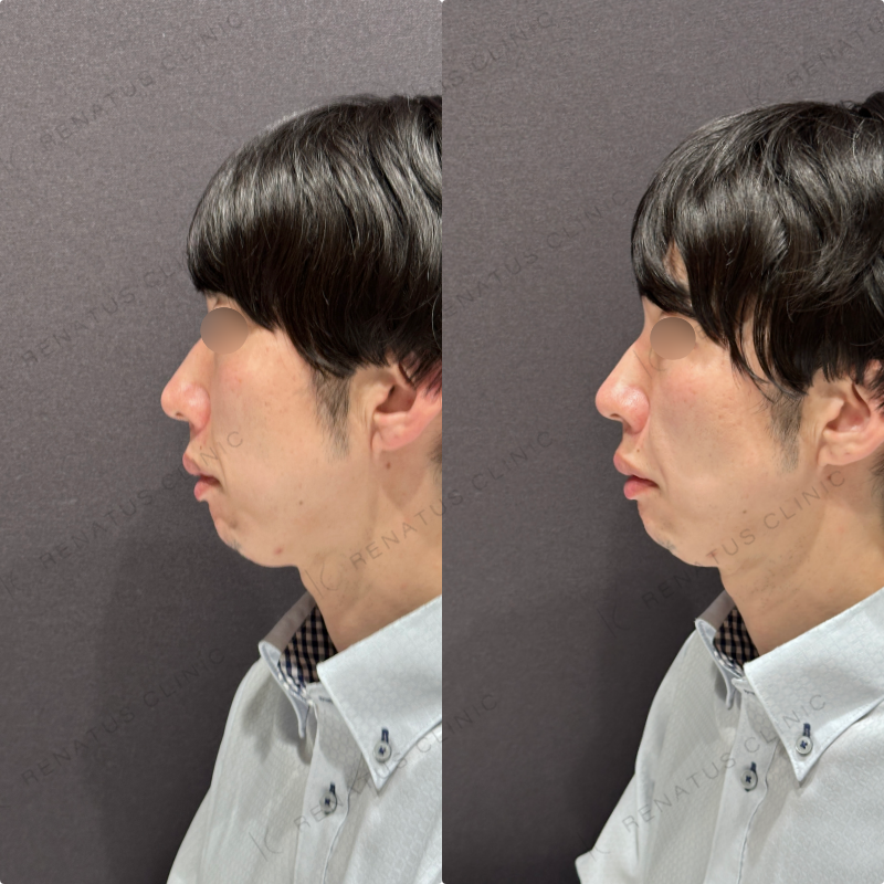 ほうれい線ヒアルロン酸ボリフト症例写真