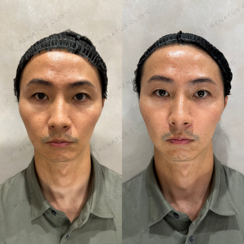 NLFヒアルロン酸ボリフト症例写真
