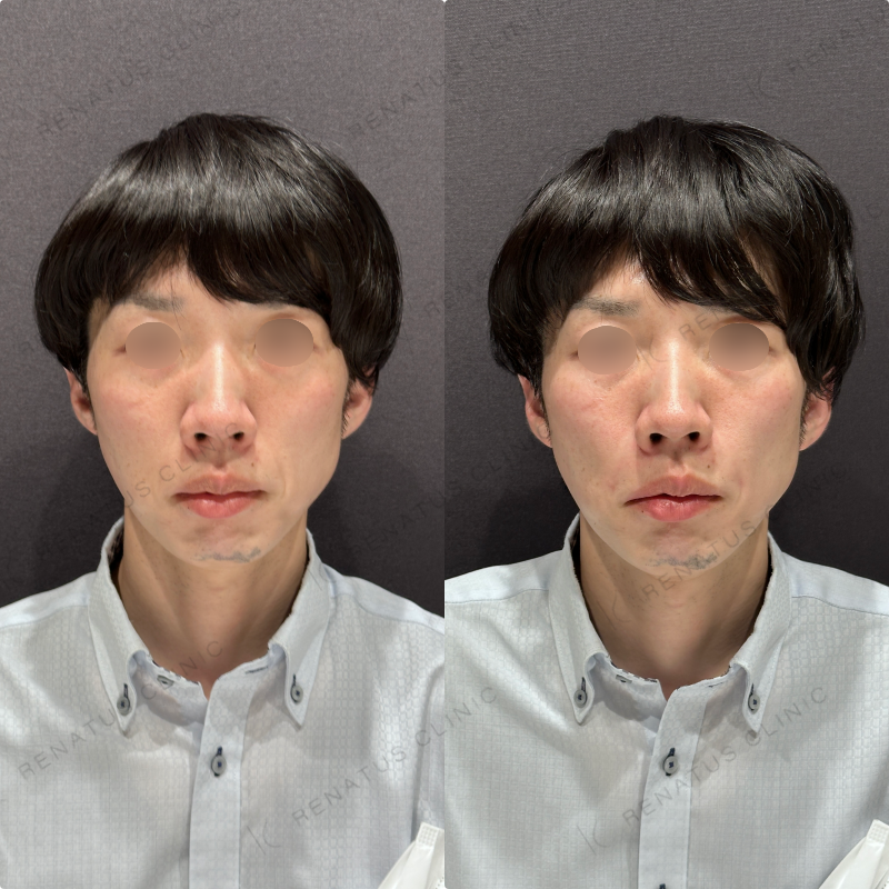 ほうれい線ヒアルロン酸ボリフト症例写真