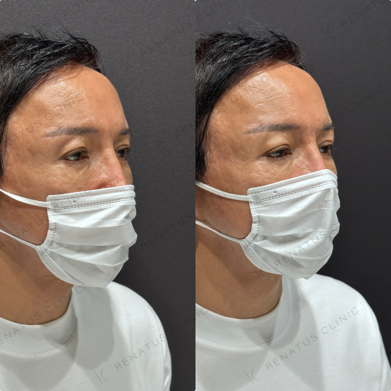 目の上ヒアルロン酸ボルベラ症例写真