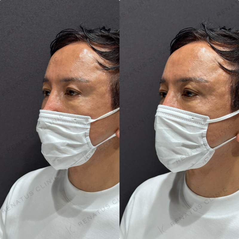 目の上ヒアルロン酸ボルベラ症例写真