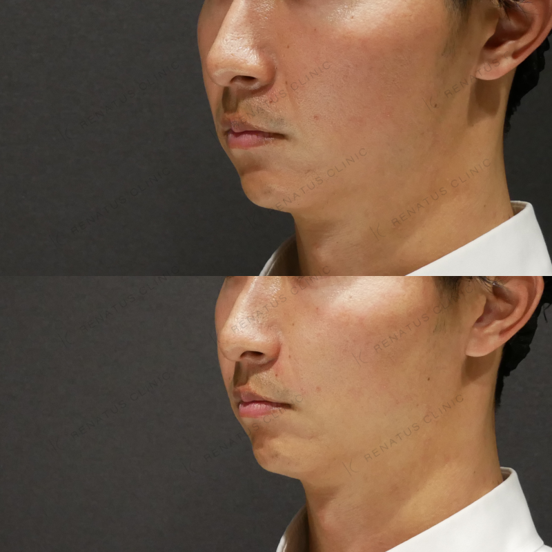 ほうれい線ヒアルロン酸ボリフト症例写真