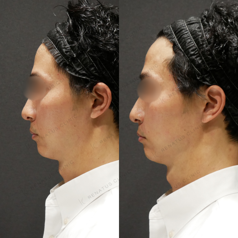ほうれい線ヒアルロン酸ボリフト症例写真