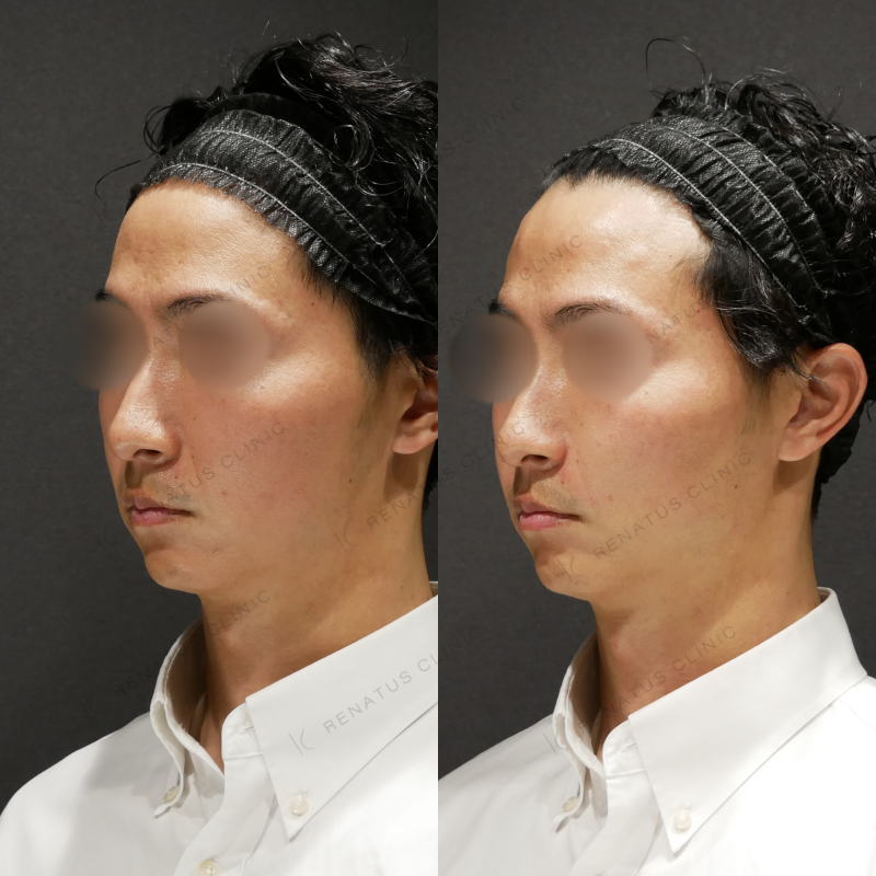 ほうれい線ヒアルロン酸ボリフト症例写真