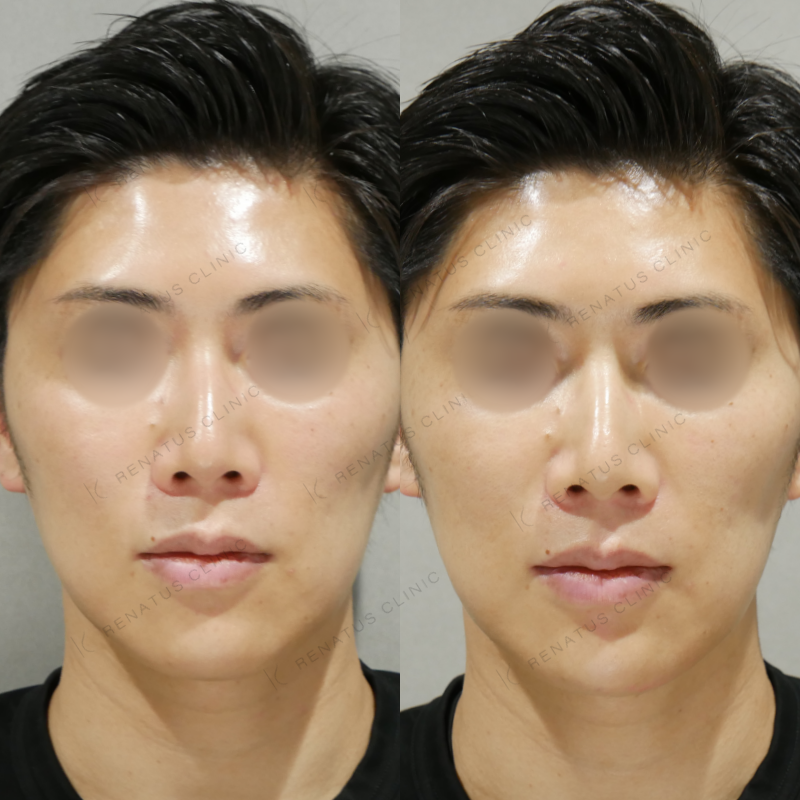 顎ヒアルロン酸ボラックス症例写真