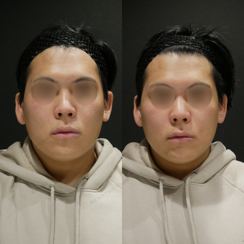 鼻翼基部ヒアルロン酸ボリフト症例写真
