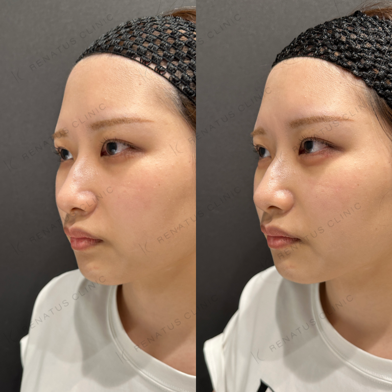 涙袋ヒアルロン酸ボルベラ症例写真