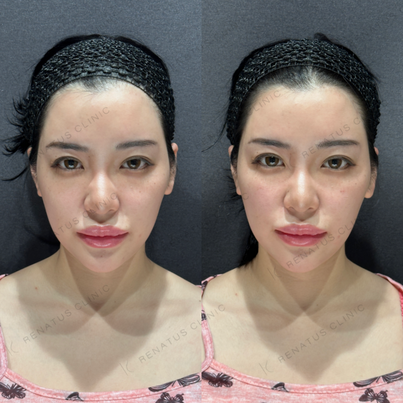 ゴルゴラインヒアルロン酸ボリューマ症例写真