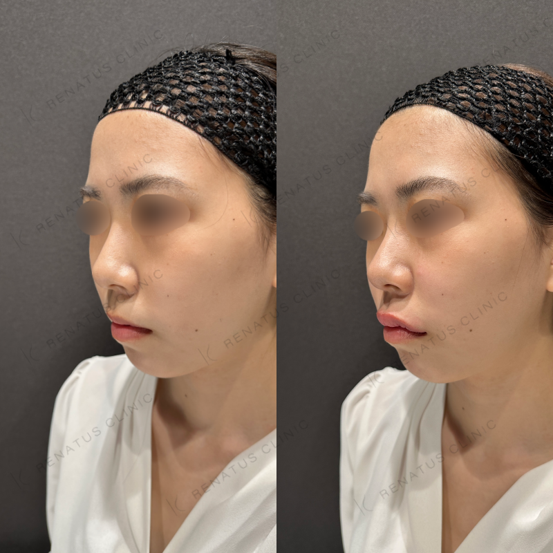 唇ヒアルロン酸ボルベラ症例写真