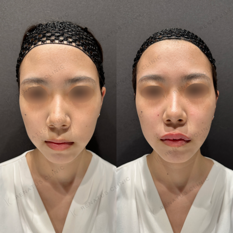 唇ヒアルロン酸ボルベラ症例写真