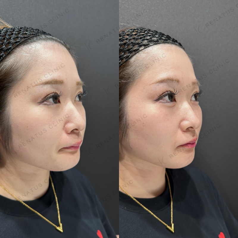 涙袋ヒアルロン酸ボルベラ症例写真