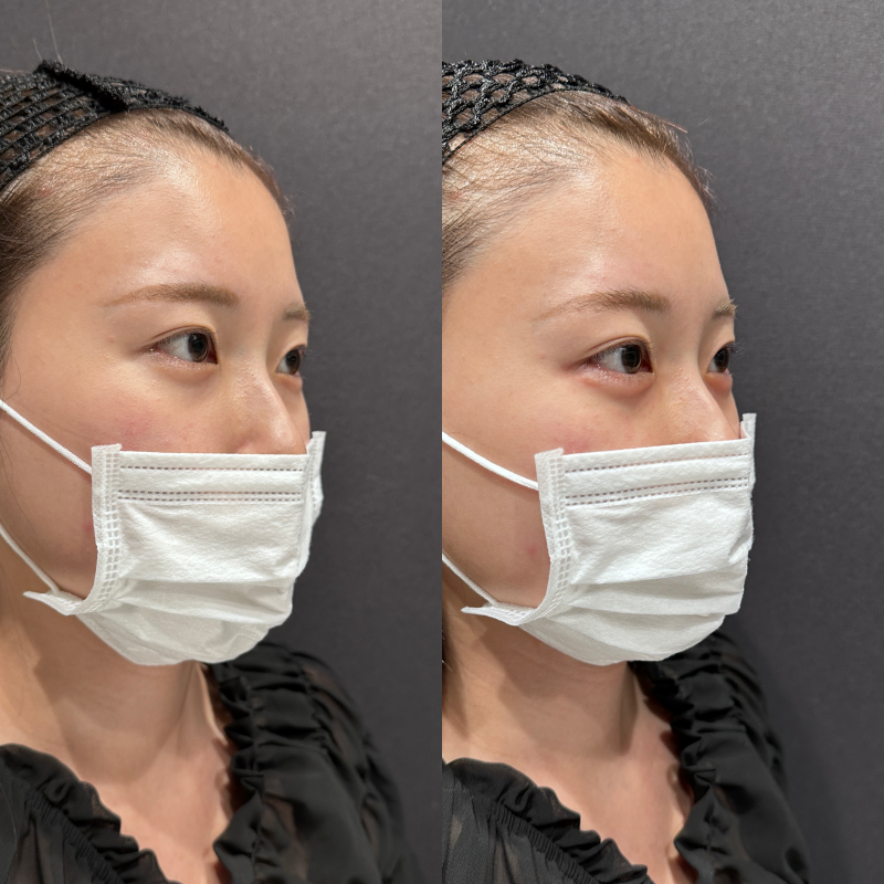 涙袋ヒアルロン酸ボルベラ症例写真