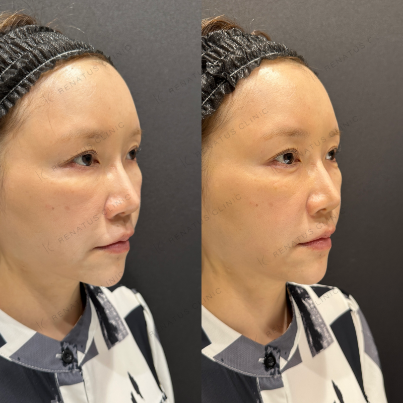 涙袋ボルベラヒアルロン酸症例写真