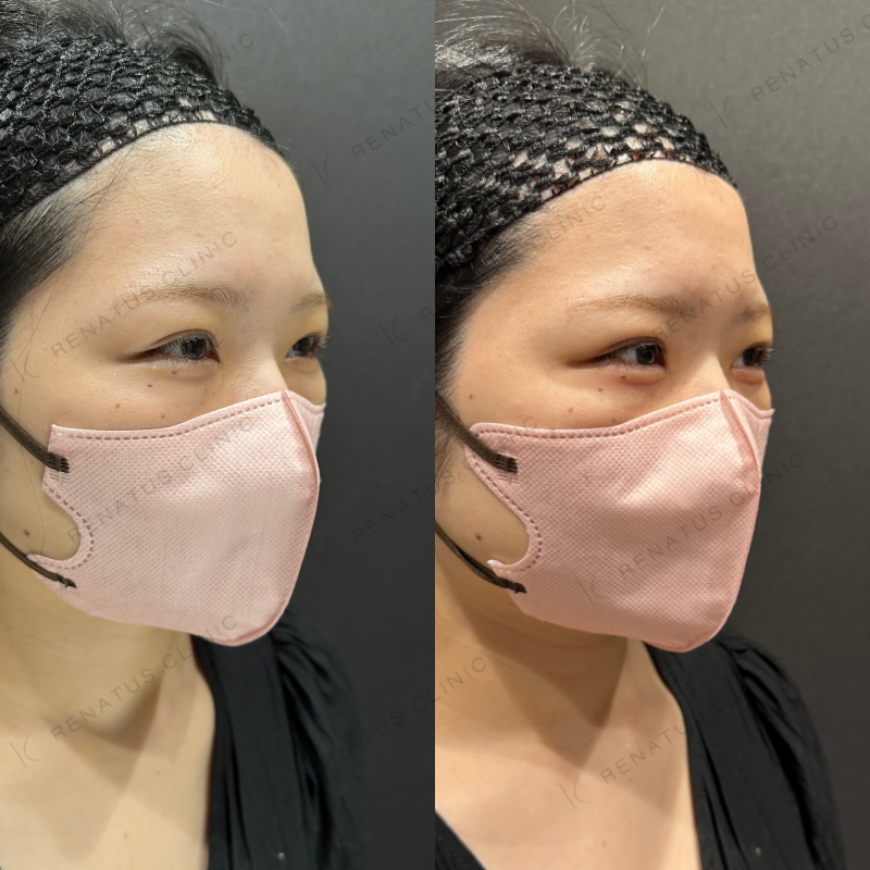 涙袋ヒアルロン酸ボルベラ症例写真
