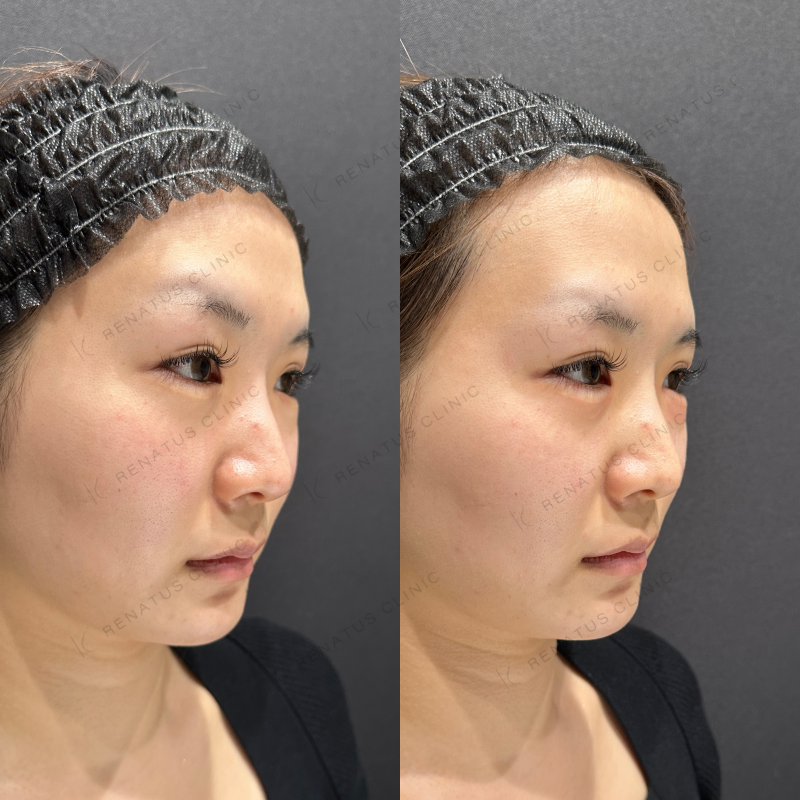 涙袋ヒアルロン酸ボルベラ症例写真