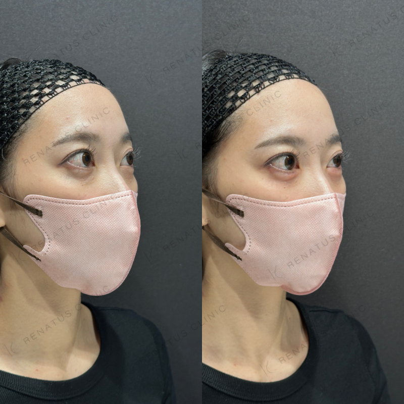 涙袋ヒアルロン酸ボルベラ症例写真