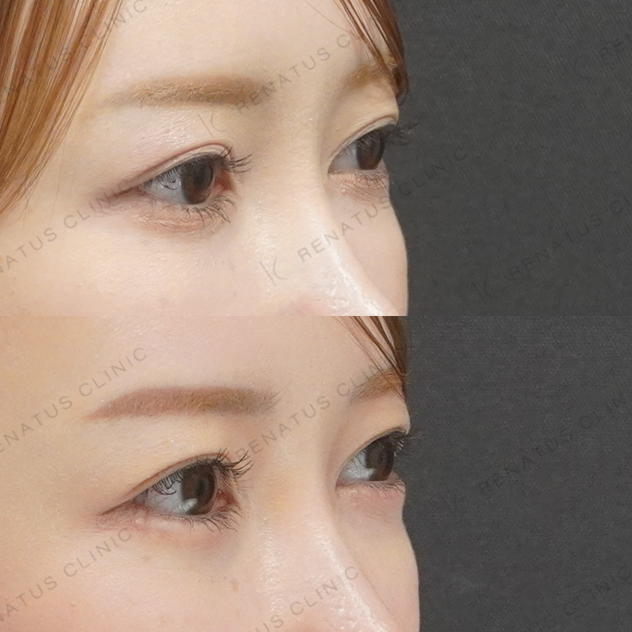 涙袋ヒアルロン酸症例写真