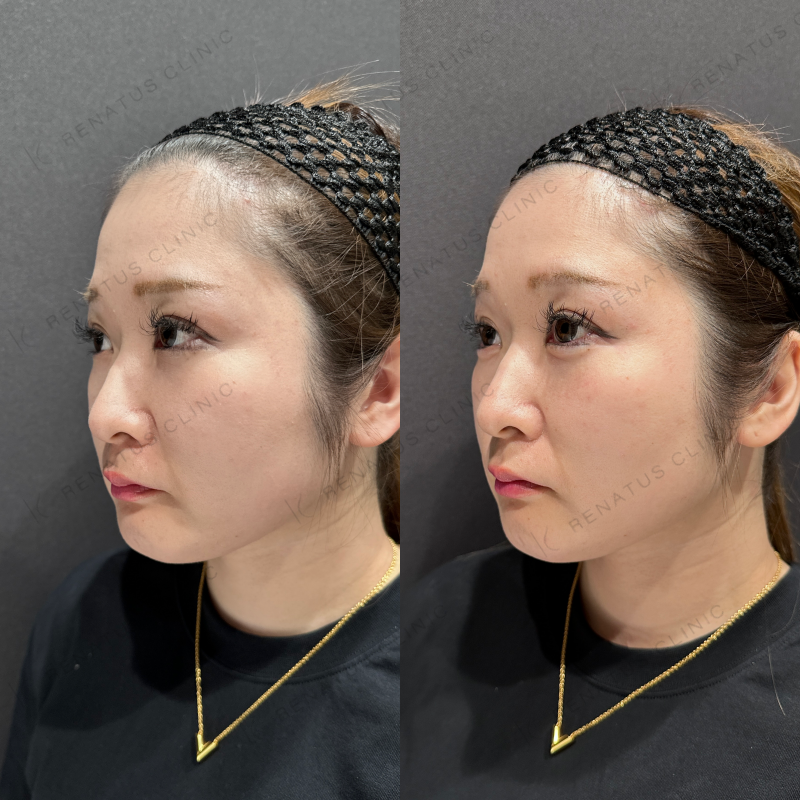 涙袋ヒアルロン酸ボルベラ症例写真