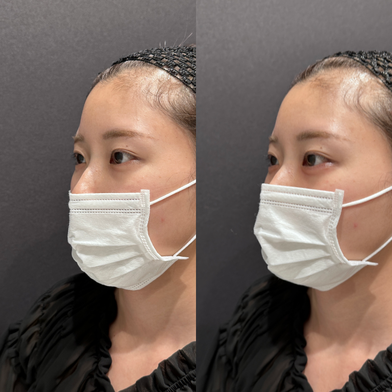 涙袋ヒアルロン酸ボルベラ症例写真