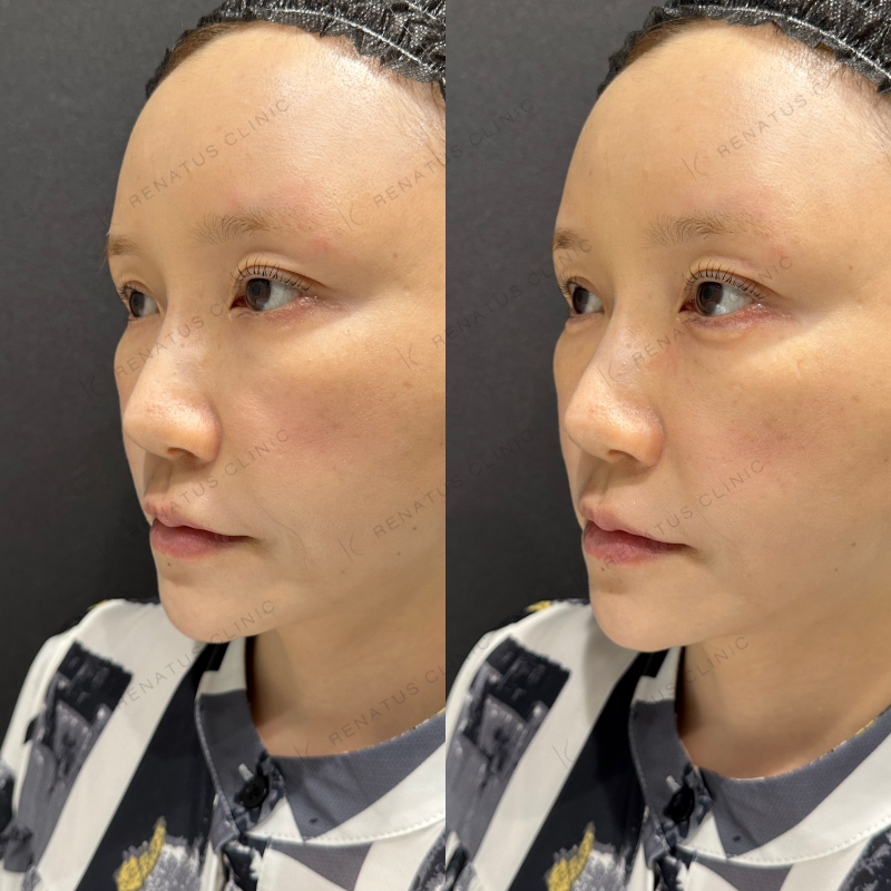 涙袋ボルベラヒアルロン酸症例写真