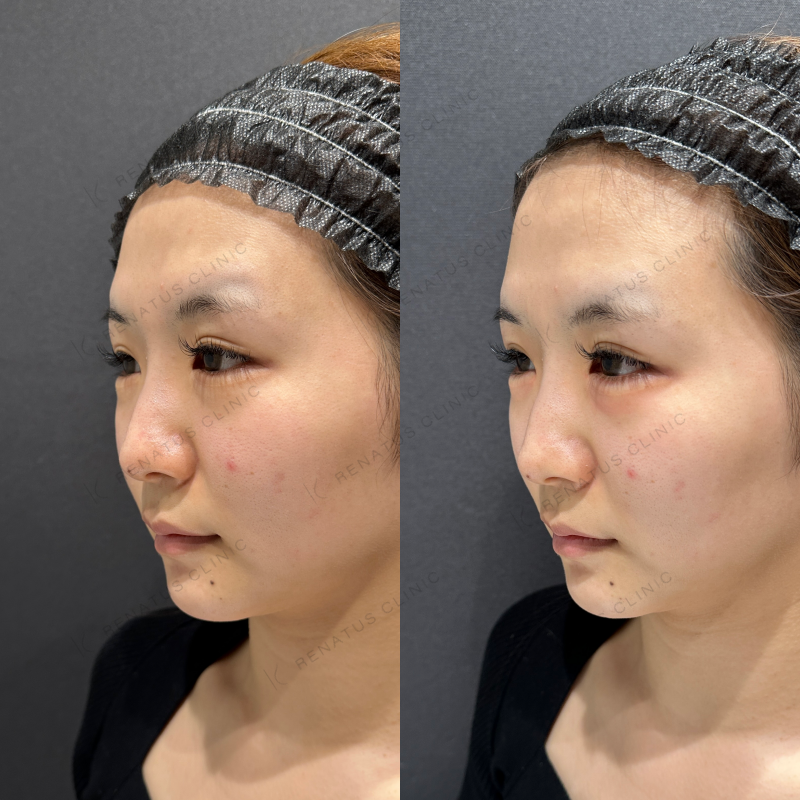 涙袋ヒアルロン酸ボルベラ症例写真