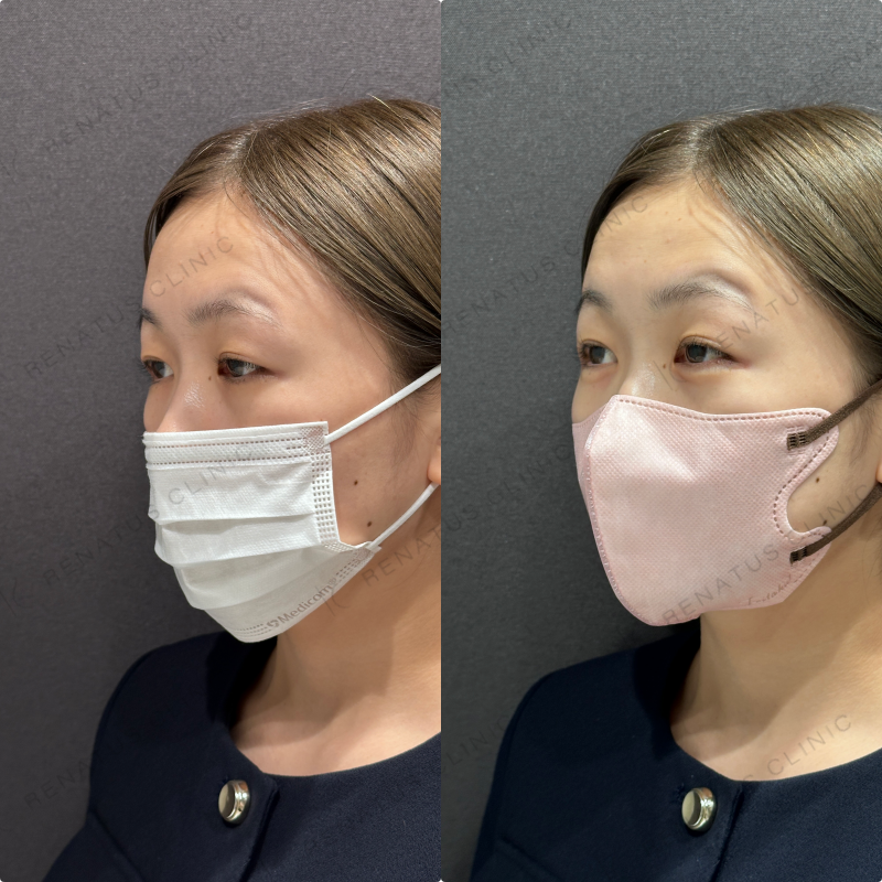涙袋ヒアルロン酸ボルベラ症例写真