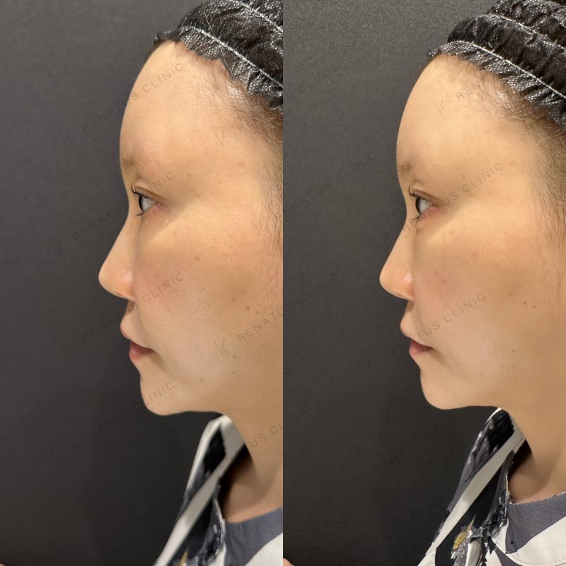 涙袋ボルベラヒアルロン酸症例写真