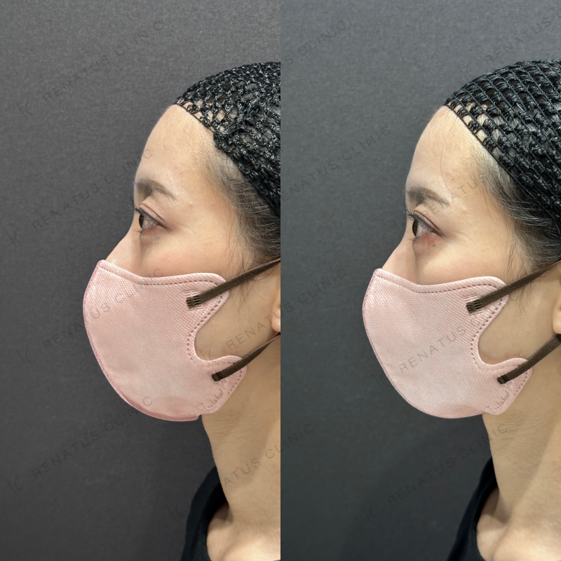 涙袋ヒアルロン酸ボルベラ症例写真