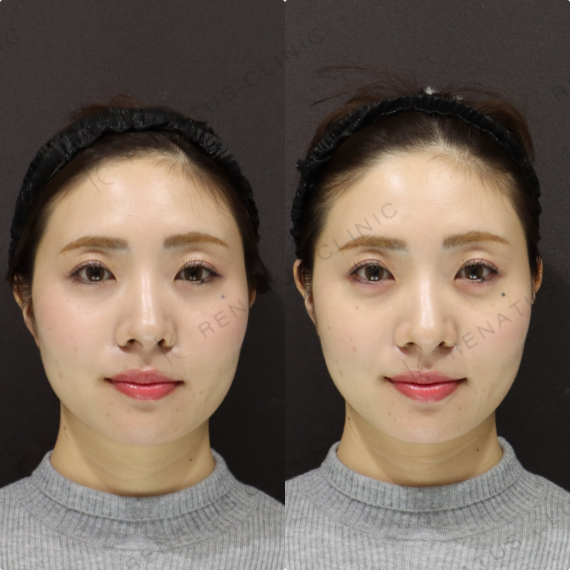 涙袋ヒアルロン酸症例写真