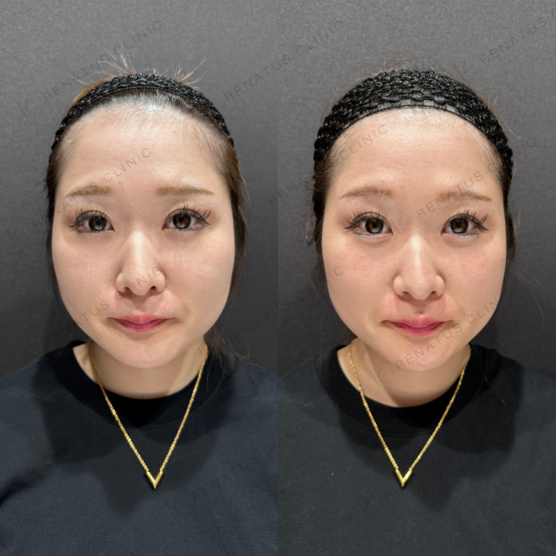 涙袋ヒアルロン酸ボルベラ症例写真