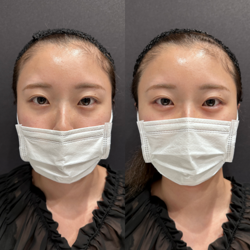 涙袋ヒアルロン酸ボルベラ症例写真