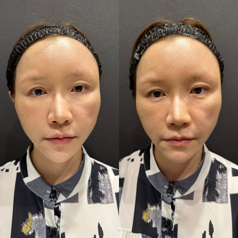 涙袋ボルベラヒアルロン酸症例写真