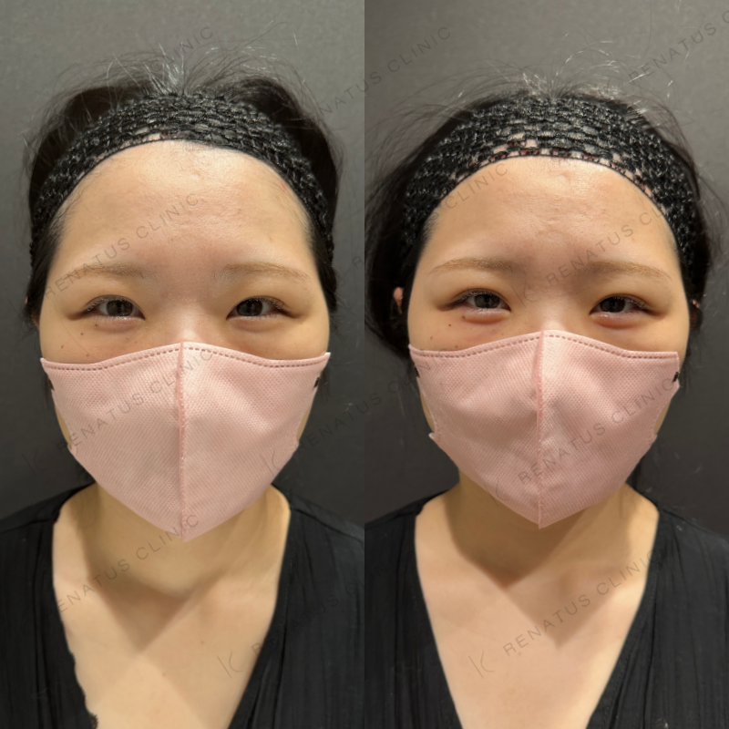 涙袋ヒアルロン酸ボルベラ症例写真