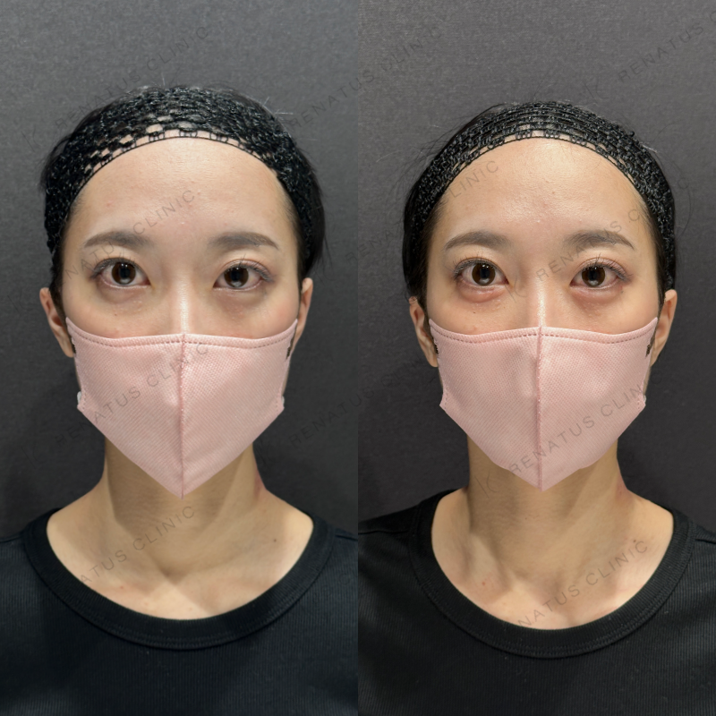 涙袋ヒアルロン酸ボルベラ症例写真