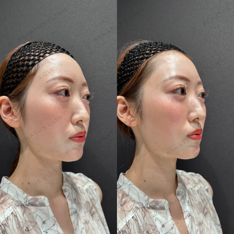 頬ヒアルロン酸ボリフト症例写真